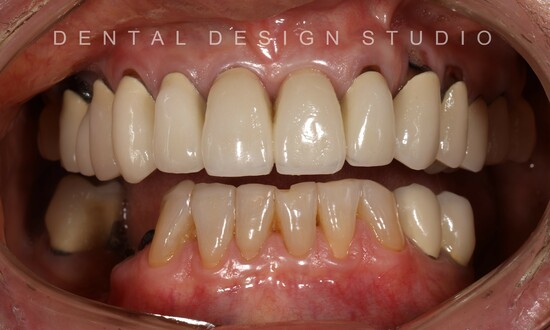 dental implants in cancun